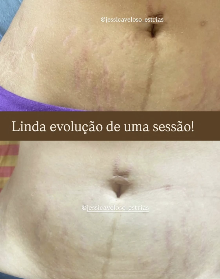 Evolução visível após uma sessão