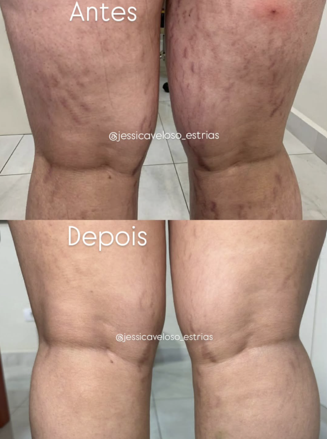 Evolução na região posterior das pernas